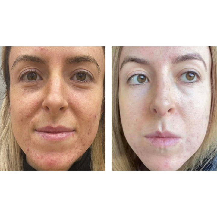 Serum & Moisturiser